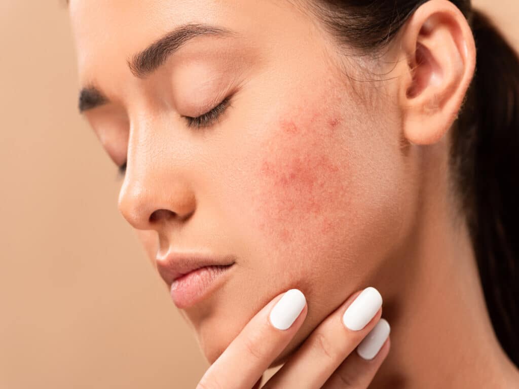 acne bootcamp by comoaesthetics by westfield in