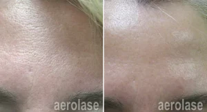 micropeel2-pair-666e0b540f62f