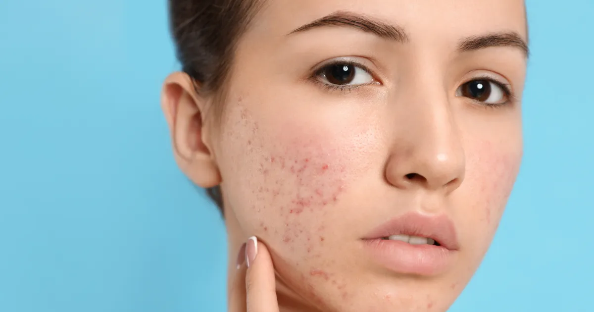 A woman looking for Acne Boot Camp treatment in Westfield to achieve clear, healthy skin