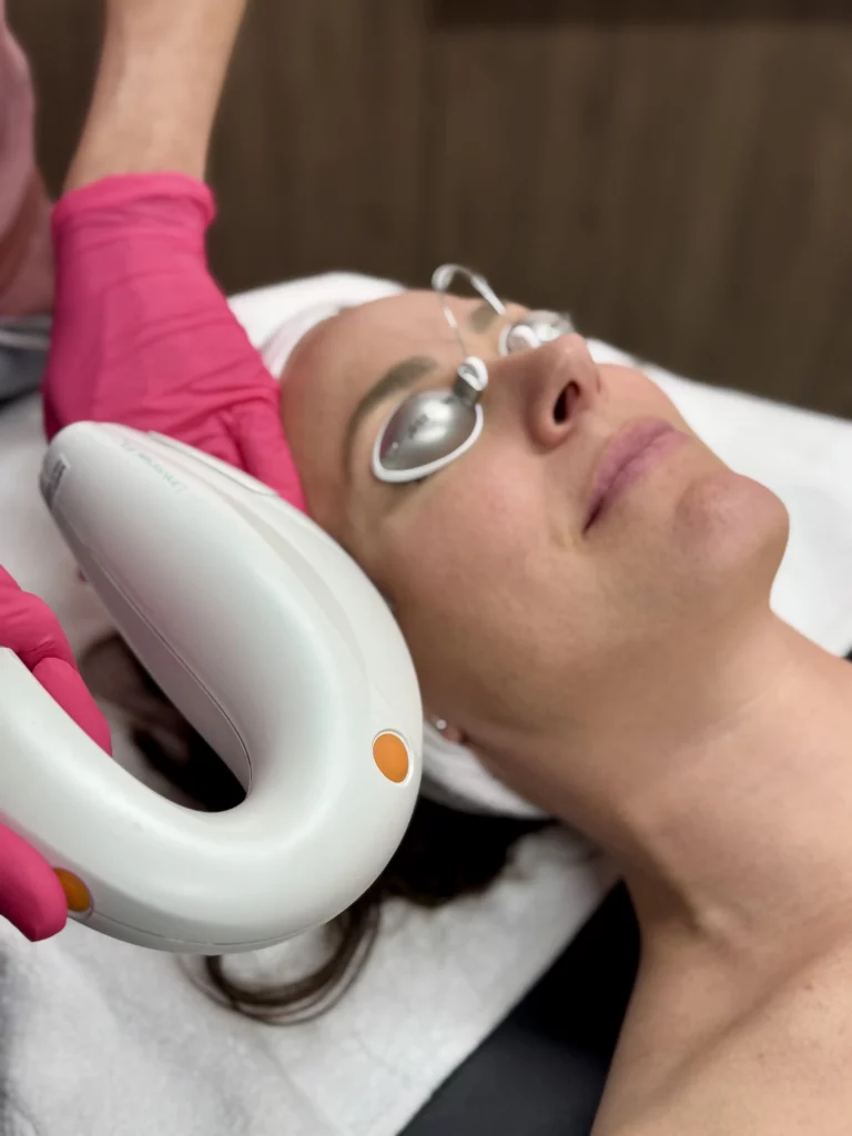 A girl having Lumenis M22 IPL Laser In Westfield, IN