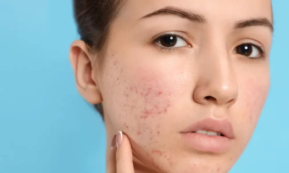 A woman looking for Acne Boot Camp treatment in Westfield to achieve clear, healthy skin